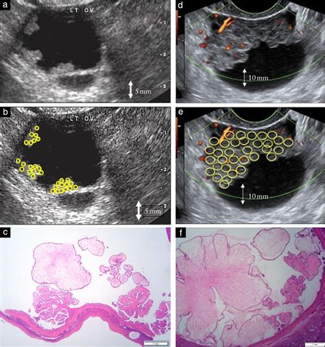 borderline tumor ovary